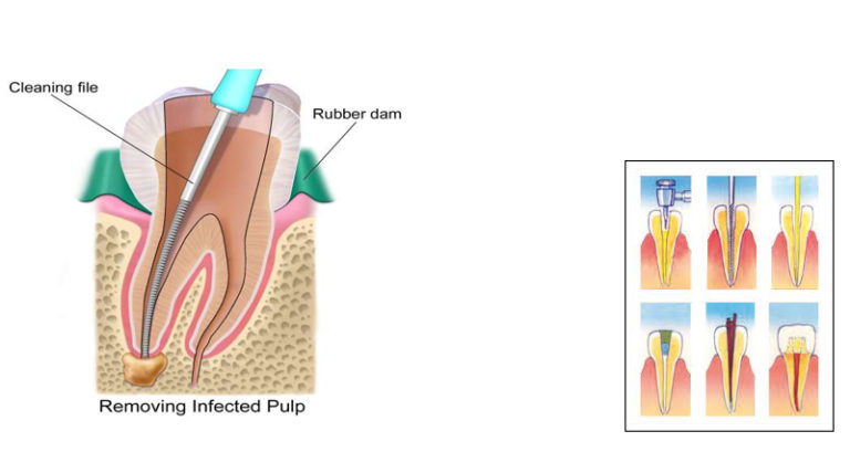 Root Canal Therapy - Showground Dental Care