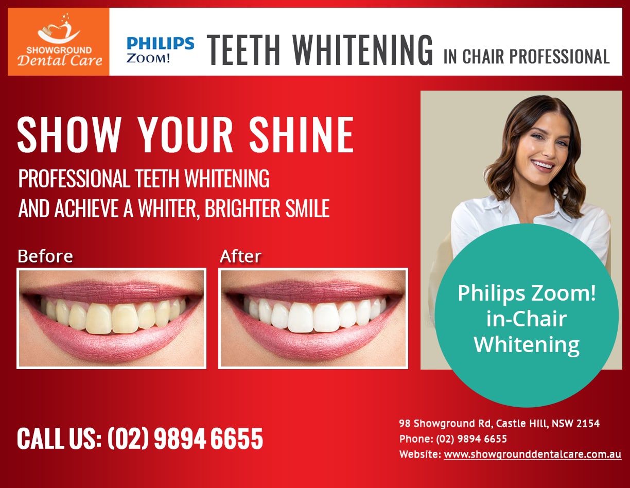 Teeth Whitening in Castle Hill, Baulkham Hills - Showground