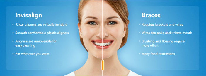 invisalign